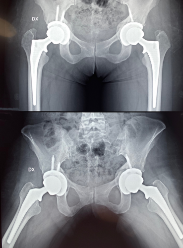 Protesi totale bilaterale di anca